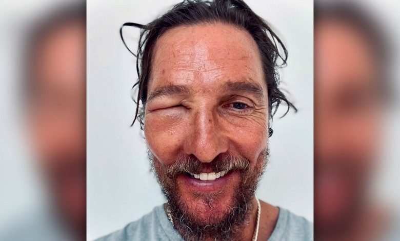 Matthew McConaughey Bee Sting: Is His Eye Okay?